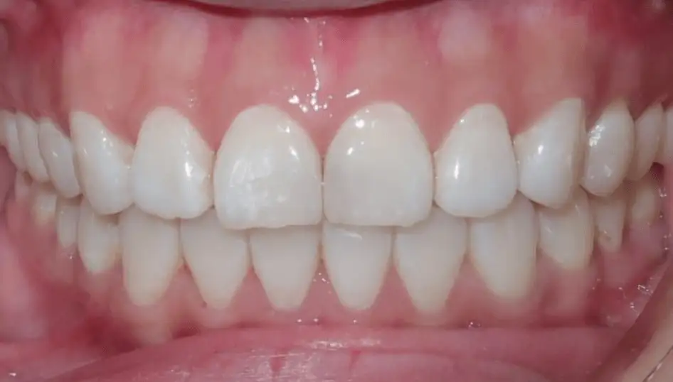 After - Front teeth aligned and open bite fully corrected