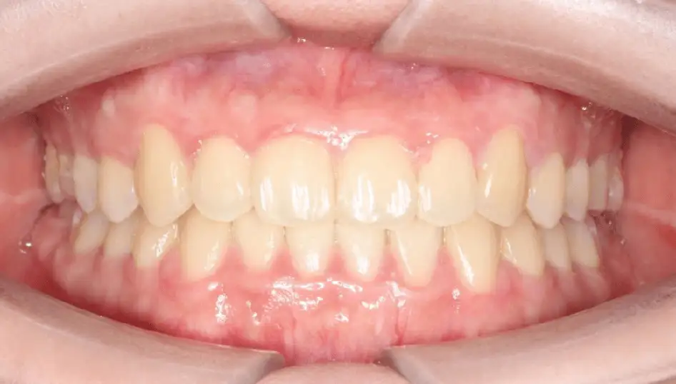 After -  Crossbite fully corrected for improved alignment and bite stability