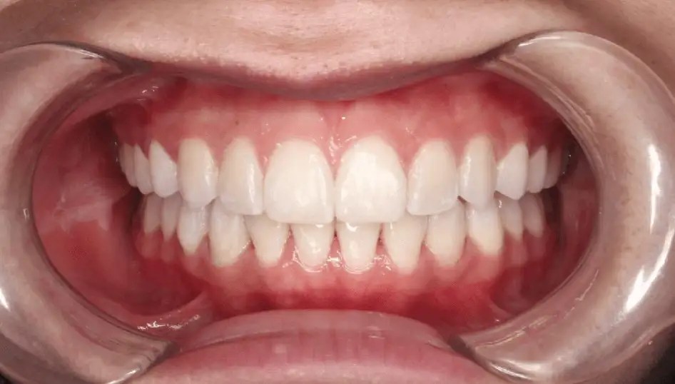 After - Teeth properly aligned for healthier, more functional results
