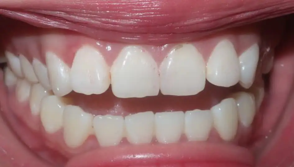 Before - Open bit of the front  teeth