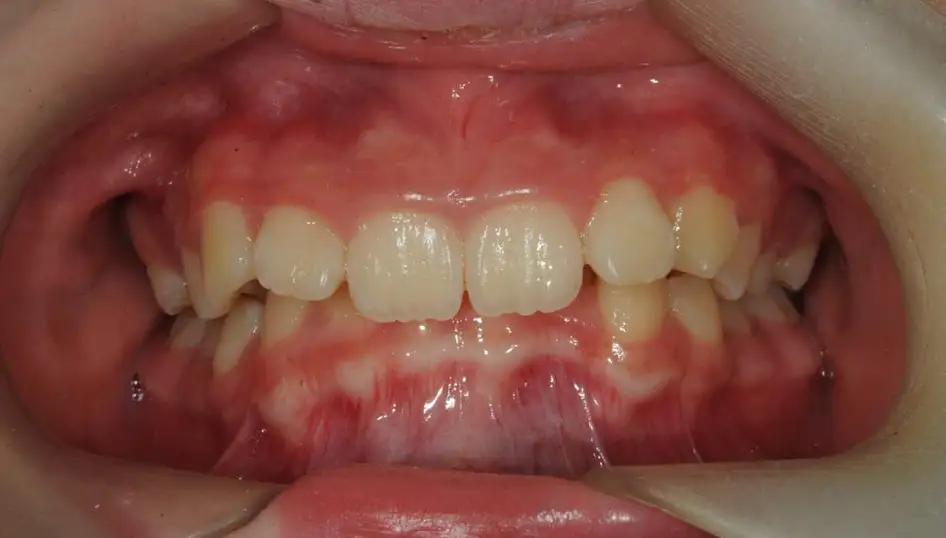 Before - Misaligned teeth with unstable bite