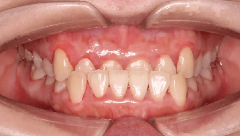 Before - Severe crossbite