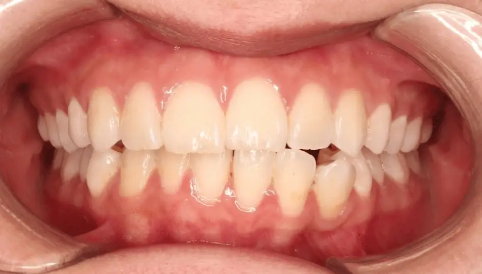 Before - Crowding affecting alignment and oral health